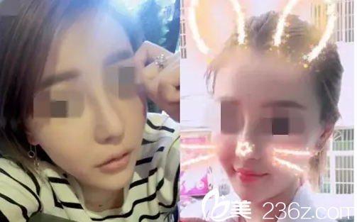 邵陽德美醫(yī)生改變了我塌鼻梁，大鼻頭，讓我重新提高了氣質(zhì)