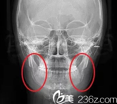 下頜角手術(shù)術(shù)后注意事項(xiàng) 下頜角手術(shù)術(shù)后注意事項(xiàng)