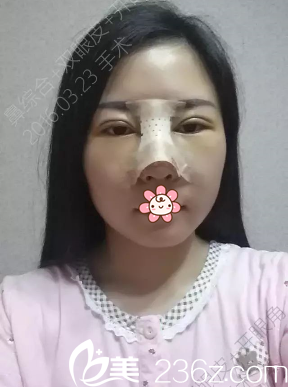 四天了，還是有點(diǎn)腫