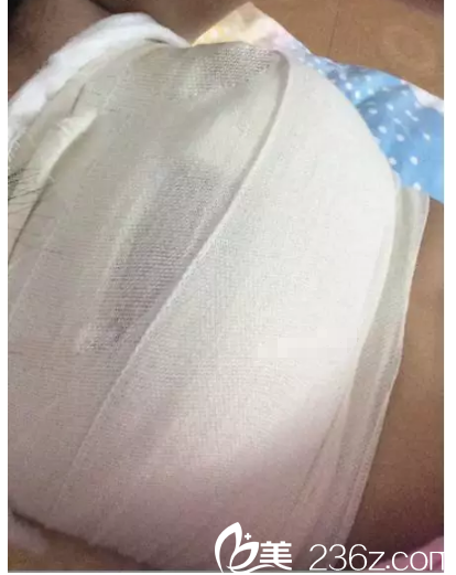 剛做完假體隆胸手術(shù) 剛做完假體隆胸手術(shù)