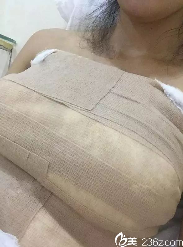 術(shù)后五天假體恢復(fù)中 術(shù)后五天假體恢復(fù)中