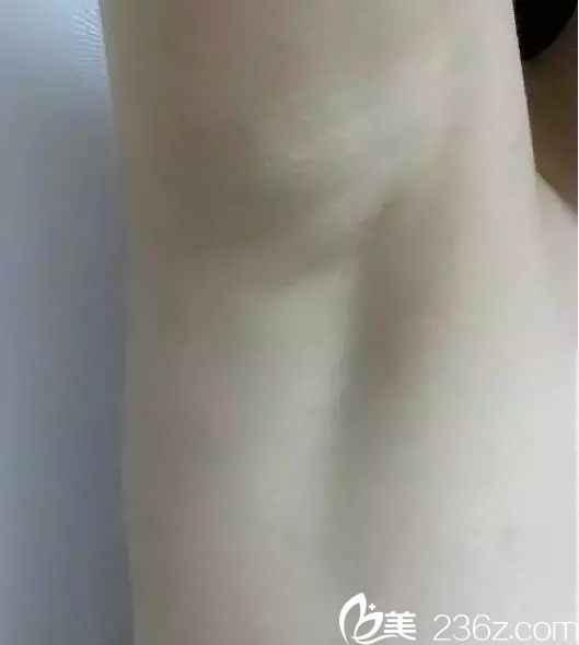 從填不滿的A-cup到傲嬌的C-cup，只因在蘇州芘麗芙華美做了進(jìn)口娜綺麗假體隆胸