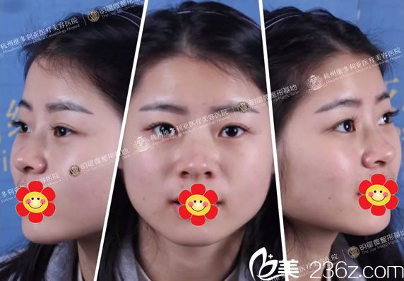 手術(shù)前面部凹陷和短寬鼻子 手術(shù)前面部凹陷和短寬鼻子