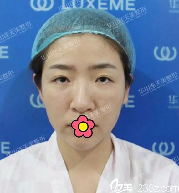 16歲做雙眼皮現(xiàn)在眼皮下垂嚴(yán)重 16歲做雙眼皮現(xiàn)在眼皮下垂嚴(yán)重