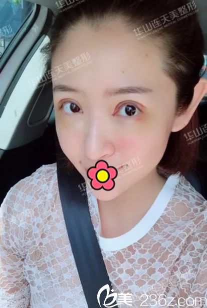 全切雙眼皮手信修復(fù)1天恢復(fù)照 全切雙眼皮手信修復(fù)1天恢復(fù)照