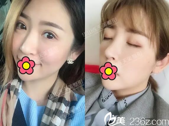 盛飛華派雙眼皮修復(fù)手術(shù)30天閉眼無(wú)痕 盛飛華派雙眼皮修復(fù)手術(shù)30天閉眼無(wú)痕