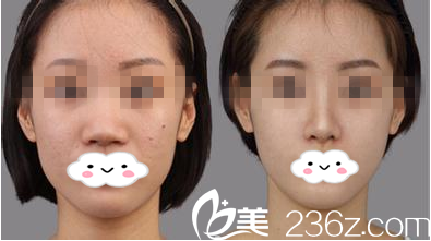 希美隆鼻前后對(duì)比圖