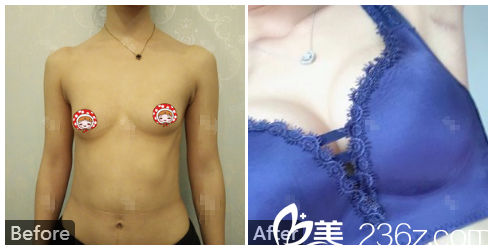 <!--<i data=20240703-sp></i>-->做的隆胸 <!--<i data=20240703-sp></i>-->做的隆胸