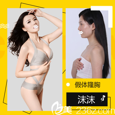 深圳鵬愛秀琪醫(yī)療美容醫(yī)院譚濤院長假體隆胸案例 深圳鵬愛秀琪醫(yī)療美容醫(yī)院譚濤院長假體隆胸案例