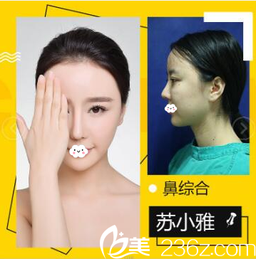 深圳鵬愛秀琪醫(yī)療美容醫(yī)院譚濤院長鼻綜合隆鼻案例 深圳鵬愛秀琪醫(yī)療美容醫(yī)院譚濤院長鼻綜合隆鼻案例