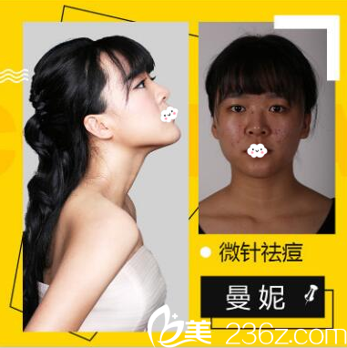 深圳鵬愛秀琪醫(yī)療美容醫(yī)院劉亞慧微針祛痘案例 深圳鵬愛秀琪醫(yī)療美容醫(yī)院劉亞慧微針祛痘案例