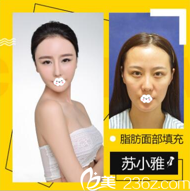 深圳鵬愛秀琪醫(yī)療美容醫(yī)院薛林兵自體脂肪面部填充全臉案例 深圳鵬愛秀琪醫(yī)療美容醫(yī)院薛林兵自體脂肪面部填充全臉案例