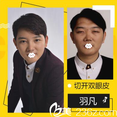 深圳鵬愛秀琪醫(yī)療美容醫(yī)院薛林兵切開雙眼皮案例 深圳鵬愛秀琪醫(yī)療美容醫(yī)院薛林兵切開雙眼皮案例