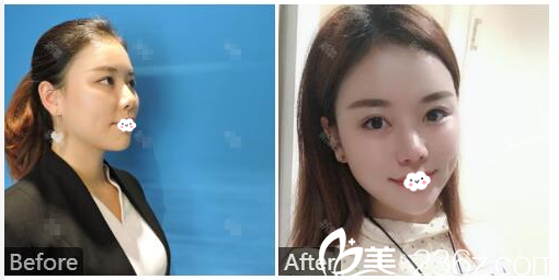 深圳鵬愛秀琪醫(yī)療美容醫(yī)院薛林兵自體耳軟骨隆鼻案例 深圳鵬愛秀琪醫(yī)療美容醫(yī)院薛林兵自體耳軟骨隆鼻案例