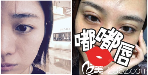 深圳麗港麗格石東文雙眼皮效果圖 深圳麗港麗格石東文雙眼皮效果圖