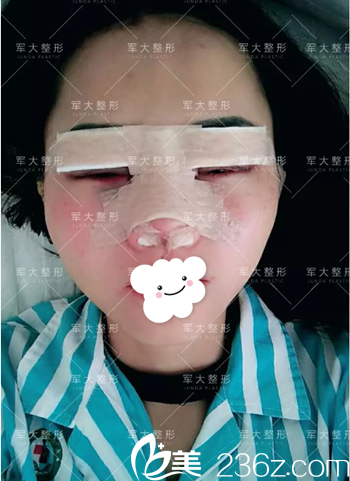 <i data-id='2257c2bc-36a4-4e95-bc55-f7ec9c660362' style='display:none;'></i>雙眼皮+隆鼻術(shù)后即刻照片