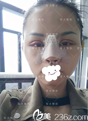 <i data-id='2257c2bc-36a4-4e95-bc55-f7ec9c660362' style='display:none;'></i>全切雙眼皮術(shù)后3天