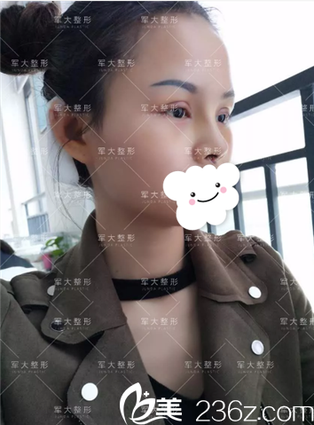 <i data-id='2257c2bc-36a4-4e95-bc55-f7ec9c660362' style='display:none;'></i>膨體隆鼻術(shù)后5天拆線