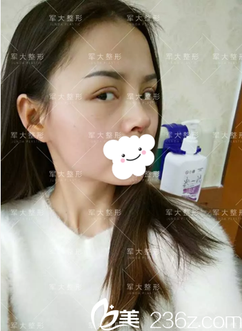 全切雙眼皮+膨體隆鼻術(shù)后10天