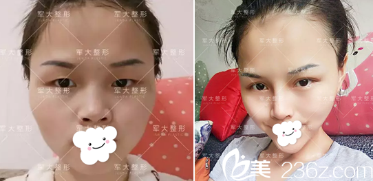 <i data-id='2257c2bc-36a4-4e95-bc55-f7ec9c660362' style='display:none;'></i>全切雙眼皮+膨體隆鼻術(shù)前術(shù)后對(duì)比