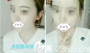 韓國春天金起雄院長面部輪廓整形，讓我變成了氣質女神