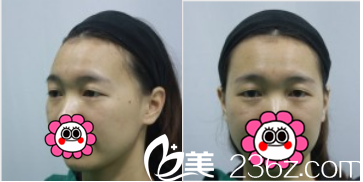 術前照片 術前照片