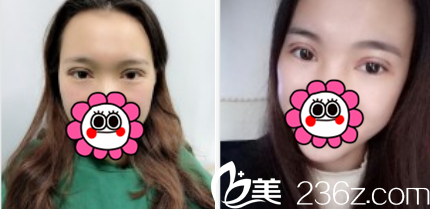 術后9天的效果 術后9天的效果