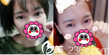 李女士展示在北京亞楠容悅醫(yī)院找蔣亞楠做切開雙眼皮+開眼角第38天照?