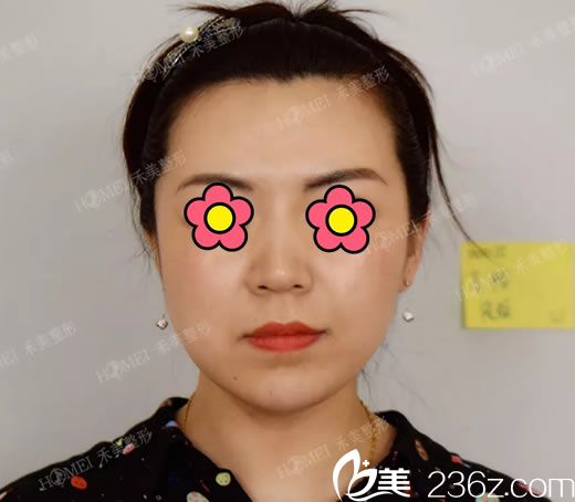 注射玻尿酸填充下巴前 注射玻尿酸填充下巴前