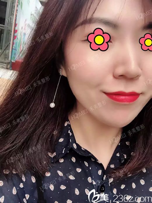 注射玻尿酸豐下巴的即刻效果圖 注射玻尿酸豐下巴的即刻效果圖