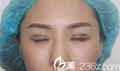 <!--<i data=20240703-sp></i>-->楊明峰雙眼皮失敗修復(fù)術(shù)后當(dāng)天照片