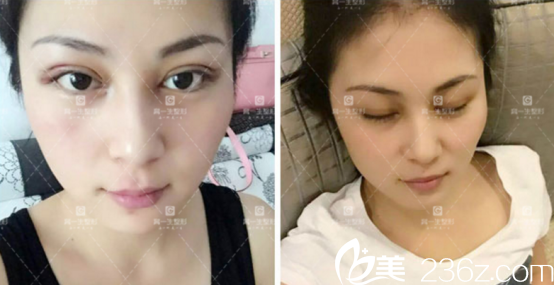 不得不說(shuō)術(shù)后第三天腫的很猛啊