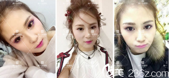 沒想到寶雞高一生做全切雙眼皮手術(shù)挺好的，現(xiàn)在分享我的恢復(fù)過程