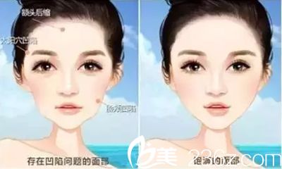 自體脂肪面部填充價(jià)格貴嗎？南寧亞韓自體填充29800元起就能幫擁有心形臉