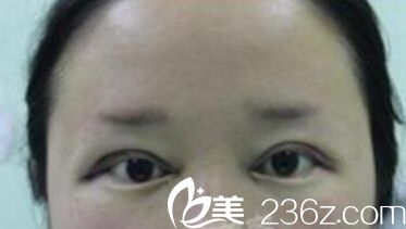 在洛陽孔繁榮做眼綜合手術(shù)