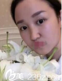 洛陽孔繁榮做眼綜合案例