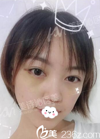 在廣州美詩沁做去眼袋5天效果