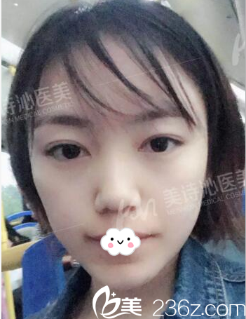 去廣州美詩沁去眼袋21天恢復(fù)情況