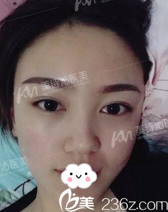 找廣州美詩沁馬滿倉院長做去眼袋一個(gè)月了