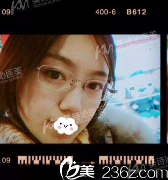 廣州美詩沁去眼袋兩個(gè)月圖片