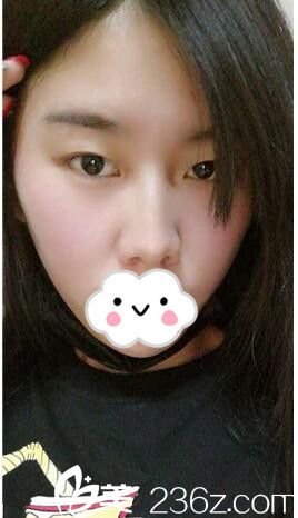 做完鼻綜合術(shù)后一月恢復(fù) 做完鼻綜合術(shù)后一月恢復(fù)