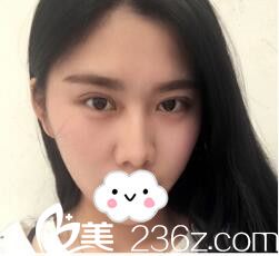 韓式雙眼皮術(shù)后三天恢復(fù) 韓式雙眼皮術(shù)后三天恢復(fù)