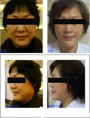 光纖熱塑瘦下巴