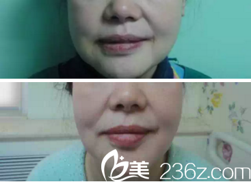 光纖熱塑瘦嬰兒肥