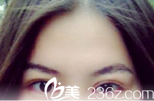 術(shù)后1個(gè)月的樣子