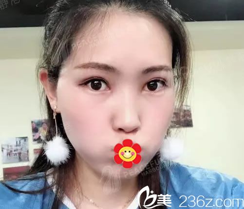 靜港林中泵割雙眼皮案例效果 靜港林中泵割雙眼皮案例效果