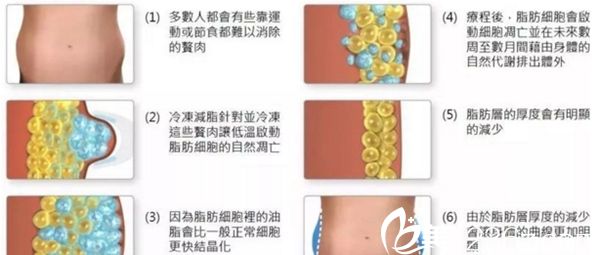 冷凍溶脂多少錢做一次？長(zhǎng)春盧立平冷凍溶脂19800元起幫你塑造性感身材