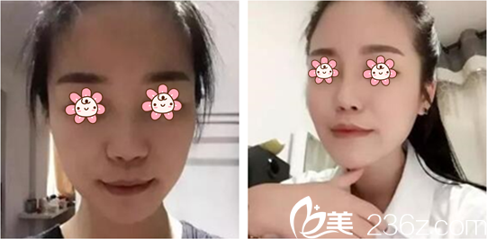 金勝翰院長隆鼻案例 金勝翰院長隆鼻案例