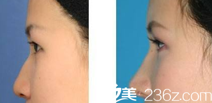 運(yùn)城麗都楊順新醫(yī)生隆鼻案例對(duì)比圖 運(yùn)城麗都楊順新醫(yī)生隆鼻案例對(duì)比圖