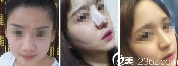 運(yùn)城麗都楊順新醫(yī)生隆鼻案例圖